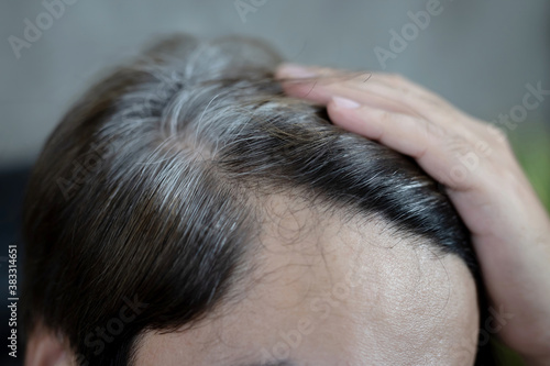 A man has hair growth, he has hair loss problems. Dry scalp, dandruff