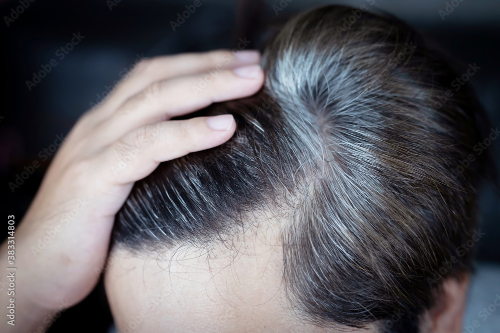 Naklejka premium A man has hair growth, he has hair loss problems. Dry scalp, dandruff