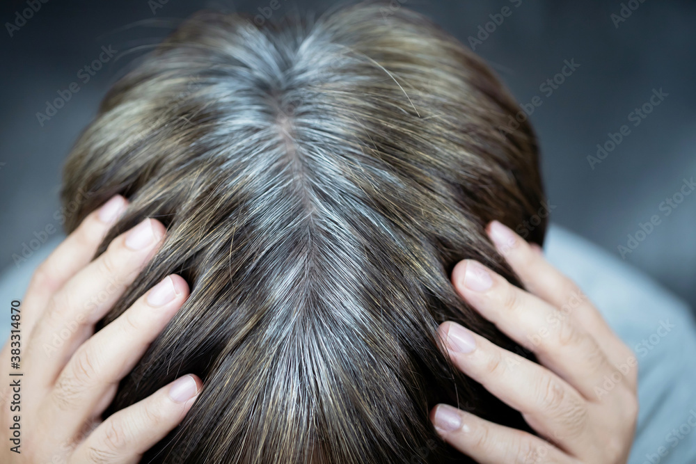 Fototapeta premium A man has hair growth, he has hair loss problems. Dry scalp, dandruff