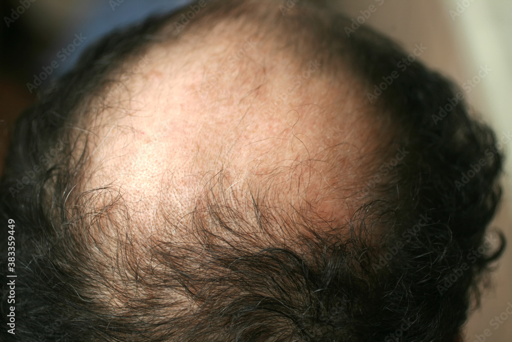 A bald spot on a man's head. Alopecia. Hair loss Stock Photo | Adobe Stock