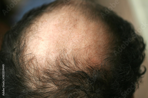 A bald spot on a man's head. Alopecia. Hair loss