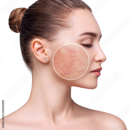 Young woman with couperose on face skin. Zoom circle shows skin problems. Isolated on white. photo