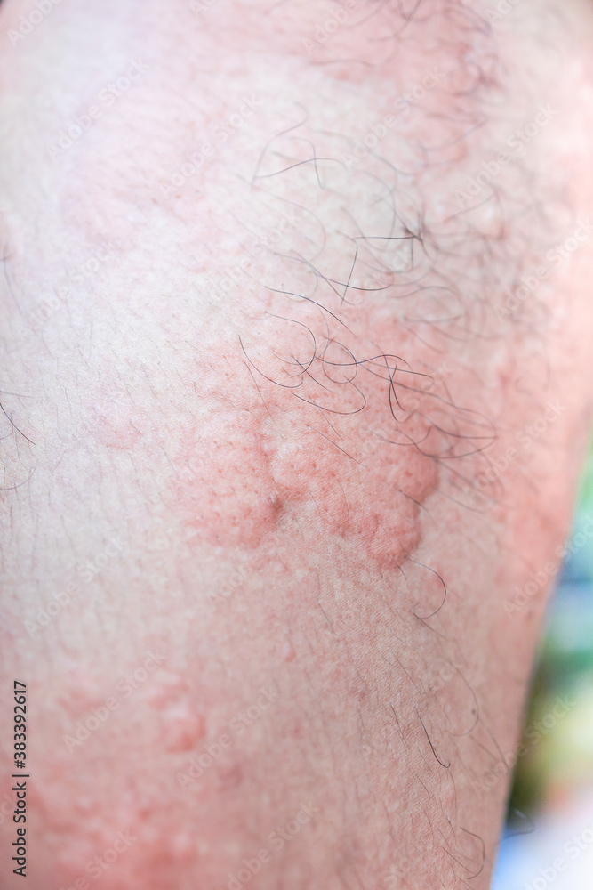 urticaria on skin. rashes, of which urticaria and toxic erythema are the most common. urticaria on skin. rashes, of which urticaria and toxic erythema are the most common.