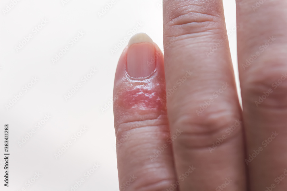 Rash allergy Inflammation on little finger Rash allergy Inflammation on little finger