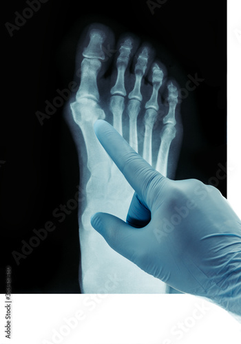 X-ray of the feet valgus deformity of the toe or a bone on a finger