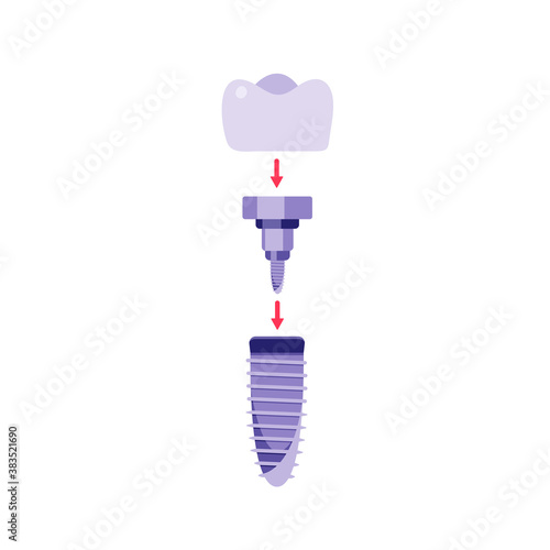 Dental implant flat cartoon illustration. Orthodontic banner design. Prostetic tooth background. Stomatology concept.