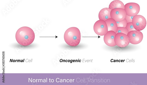 mechanism of formation of cancer cells, a mutation in p53 or Rb gene causes metastasis and malignant tumor formation. oncogenic events like mutation, UV light carcinogens also lead to tumorigenesis photo