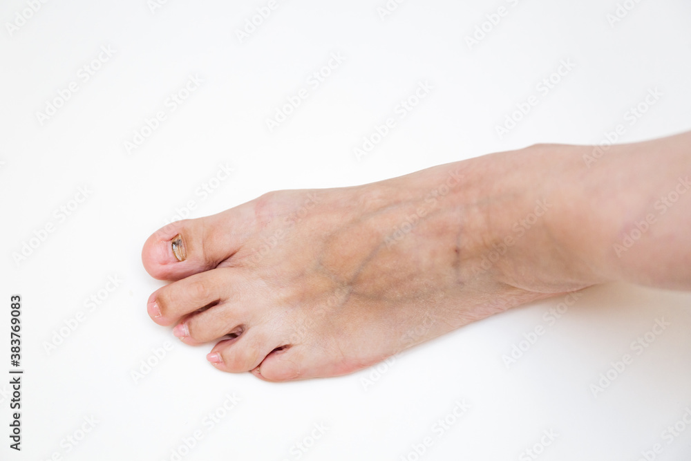 Fungal infection of the toenails. The result of wearing tight shoes. A