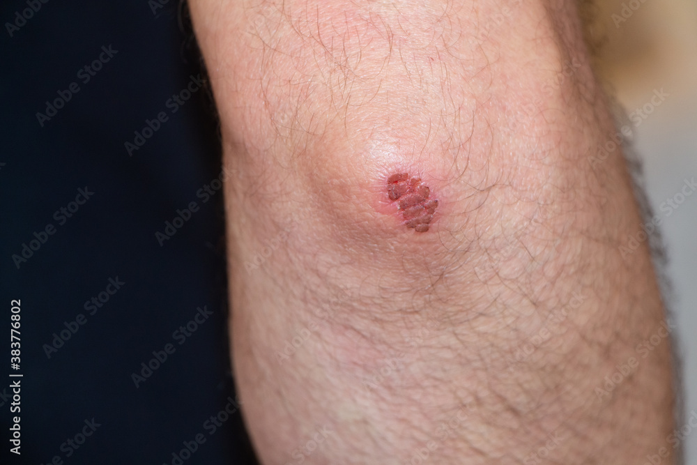 Fototapeta premium Close up on an elbow grazed