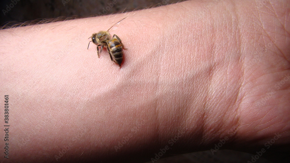 bee : apis mellifera treatment by honey bee sting closeup honey bee stinging a hand close up bee worker insects, insect, animal, wildlife, wild nature, forest, woods, garden beauty of pollination	