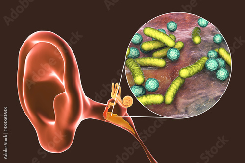 Otitis media, inflammatory disease of the middle ear photo