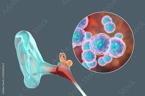 Otitis media, inflammatory disease of the middle ear photo