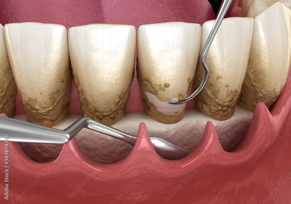 Open curettage Scaling and root planing (conventional periodontal