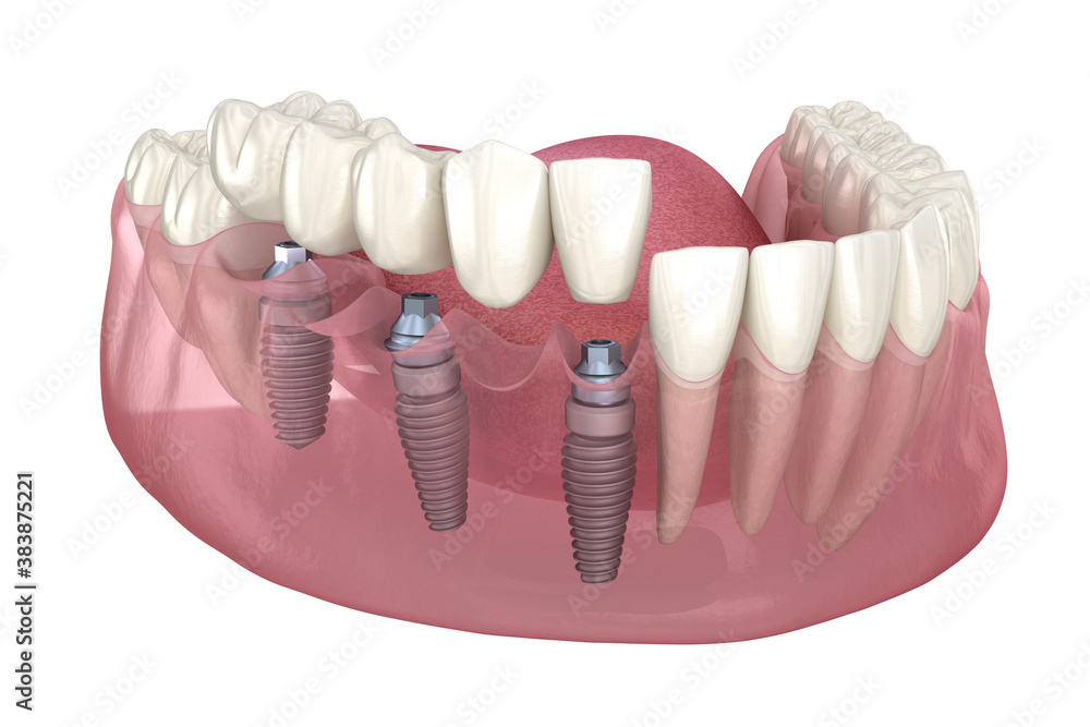 Dental bridge based on 3 implants. Medically accurate 3D illustration of human teeth and dentures concept - obrazy, fototapety, plakaty 