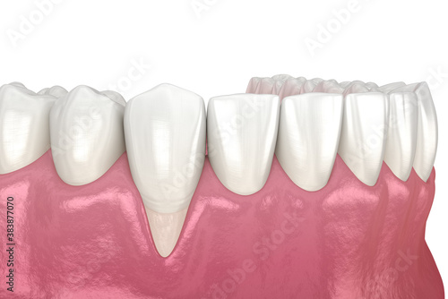 Gum Recession. 3D illustration of Dental problem photo