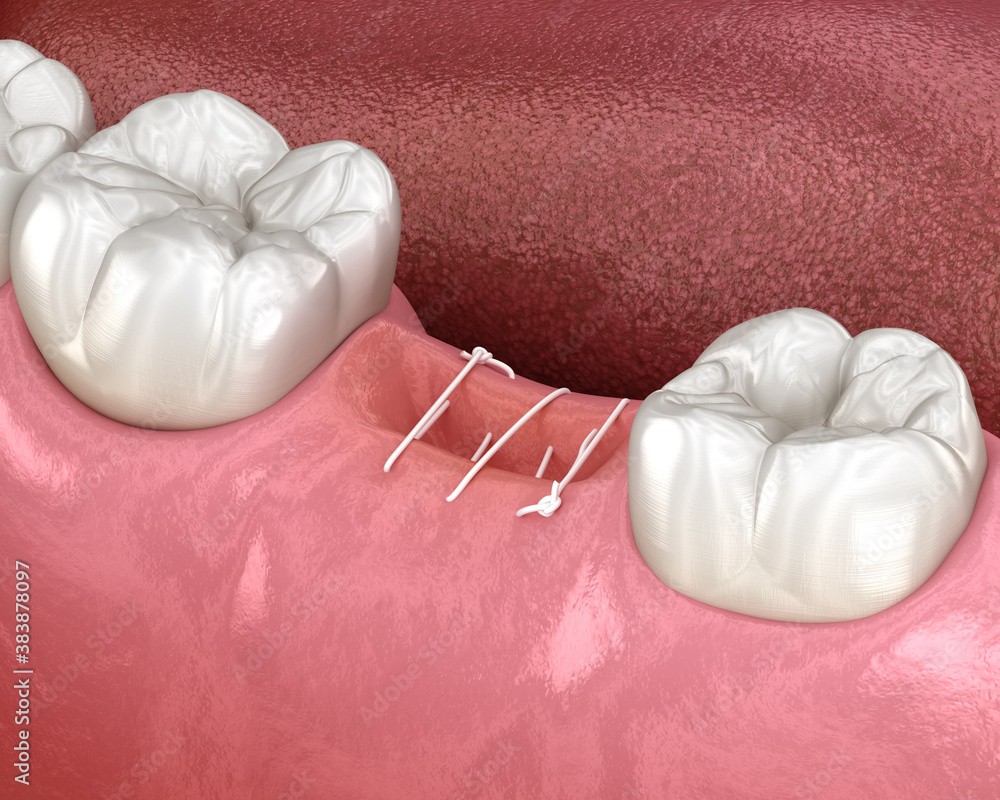 Stitches in gum after tooth extraction. 3D illustration of dental