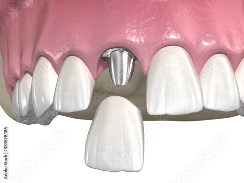 Custom abutment  dental implant and ceramic crown. Medically accurate tooth 3D illustration