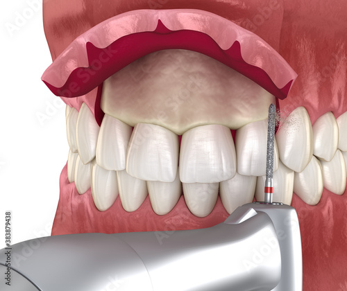 Obraz na plátně Frontal crown lengthening, Esthetic surgery