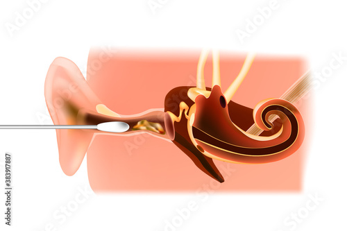 Section of the ear with the earwax. Model of the inner ear. Cleaning the auditory canal with a cotton swab. Removing earwax.
