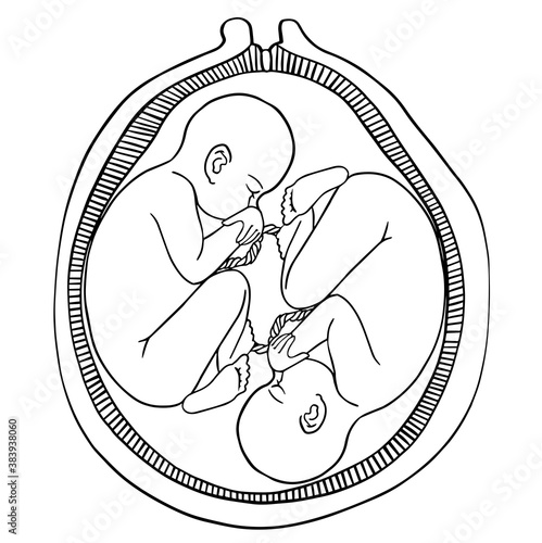 Human twins fetus concept hand drawn vector illustration prenatal growing baby, umbilicle cord. For cards, posters, coloring book,for scientific journals book illustrations