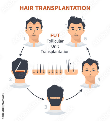 Stages of hair transplantation FUT Follicular Unit. Treatment of baldness, alopecia, mens hair loss. Vector medical circle infographics, a male head scalp. Strip, graft machine.