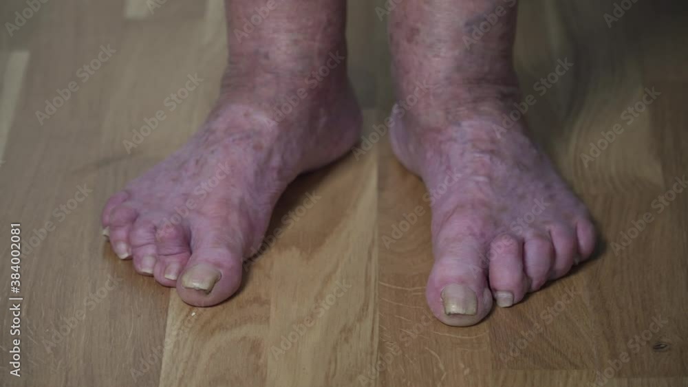 Sore toenails closeup unrecognizable person, old man. A poor woman's human feet look scary and horrible with long, uncut nails. Wrinkled spotted legs senior female Sore toenails closeup unrecognizable person, old man. A poor woman's human feet look scary and horrible with long, uncut nails. Wrinkled spotted legs senior female
