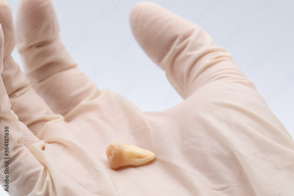 A dentist hand with medical glove examines wrenched wisdom teeth. The concept of oral care and cleaning teeth. A dentist hand with medical glove examines wrenched wisdom teeth. The concept of oral care and cleaning teeth.