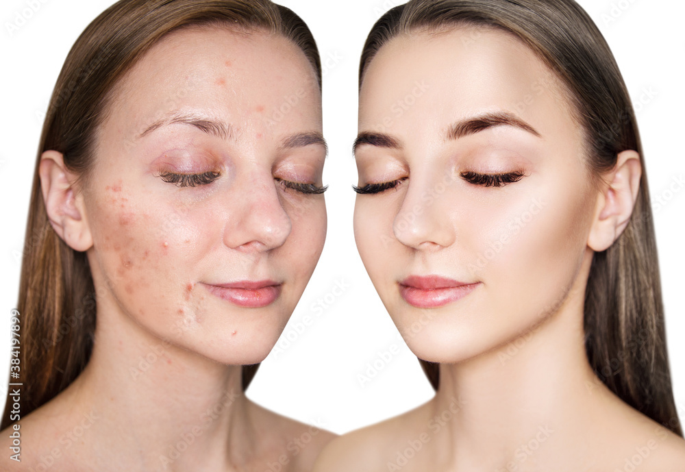 Face of beautiful woman before and after acne treatment. Beautician concept. Face of beautiful woman before and after acne treatment. Beautician concept.