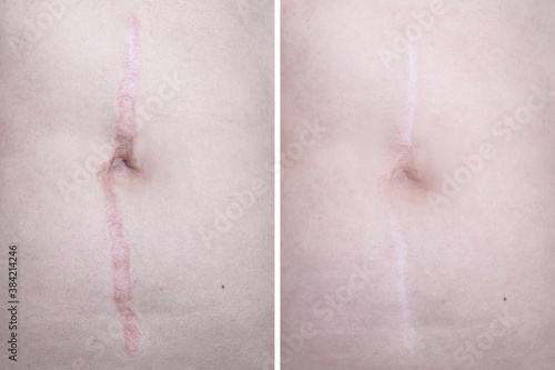 Hypertrophic keloid scar on woman stomach before and after laser treatment, removal, heal and recovery after accident or damage, cosmetology and pastic surgery solution photo