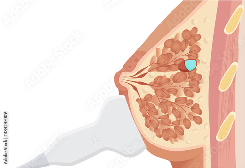 Ultrasound of the simple cyst of the breast vector illustration