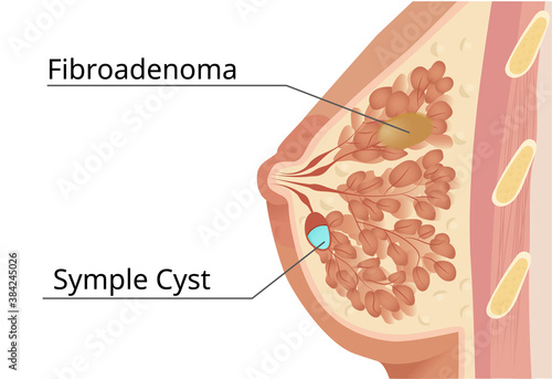 Fibro-cystic mammry gland lesions. Illustration of the fibroadenoma and cyst within the breast tissue