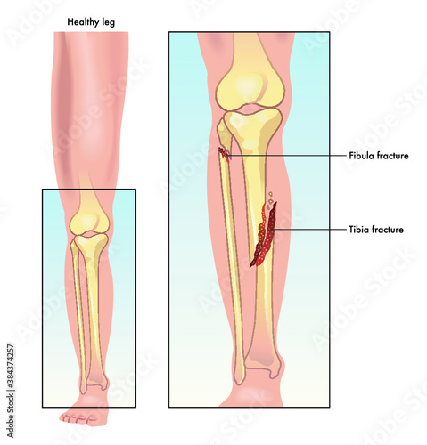 Medical illustration comparing a healthy leg to one with a fractured tibia and fibula.
