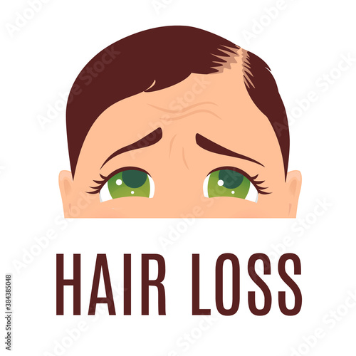 Woman suffering from hair loss. Alopecia treatment and transplantation concept. Can be used by clinics and diagnostic centers. Isolated vector illustration. 
