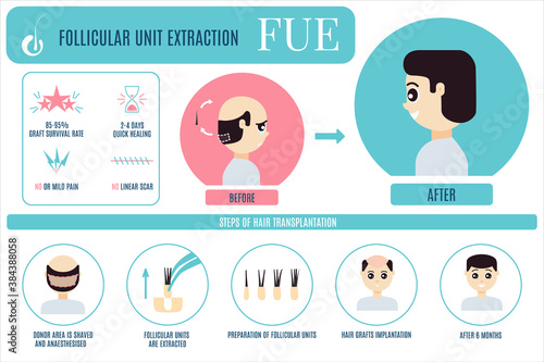 Male hair loss FUE medical treatment infographic. Stages and benefits of follicular unit extraction procedure for men. Alopecia vector template for transplantation clinics and diagnostic centers.