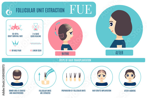 Female hair loss FUE medical treatment vector infographic. Stages and benefits of follicular unit extraction procedure for women. Alopecia design  for transplantation clinics and diagnostic centers.