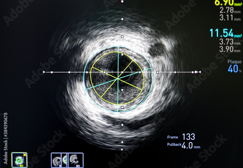 Slika na platnu Intravascular ultrasound imaging (IVUS) for assessment inside coronary artery, c