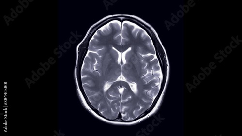 MRI brain or magnetic resonance imaging in axial T2W View.   photo