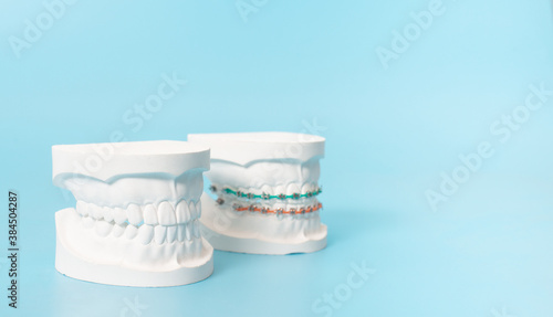Examples of dental models and orthodontic models on a blue background and copy space.