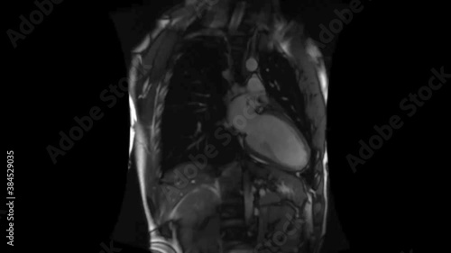 human heart mri in real time, heartbeat, frontal