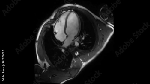 human heart mri in real time, heartbeat