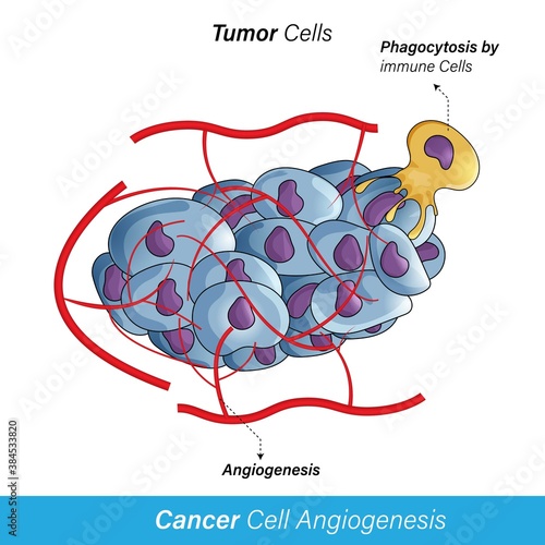 Supply of oxygen and nutrients to tumor/cancer cells lead to  proliferation, metastasis and angiogenesis , concept of phagocytosis of cancer cell by immune cell. in white background vector concept