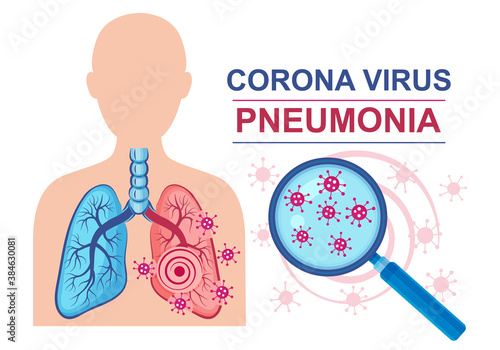 Corona virus pneumonia disease sign. Lungs infection. Normal and affected lung against of male silhouette. Coronavirus under magnifying glass. Treatment inflammation human respiratory system. Vector 