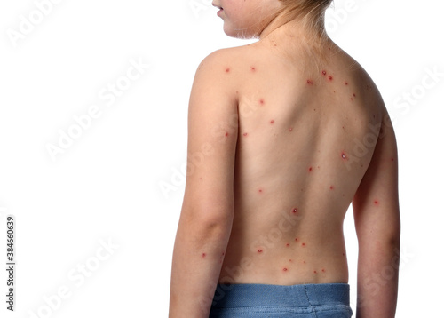 Tablou pe pânză Chickenpox disease pimples on baby girl back and shoulders
