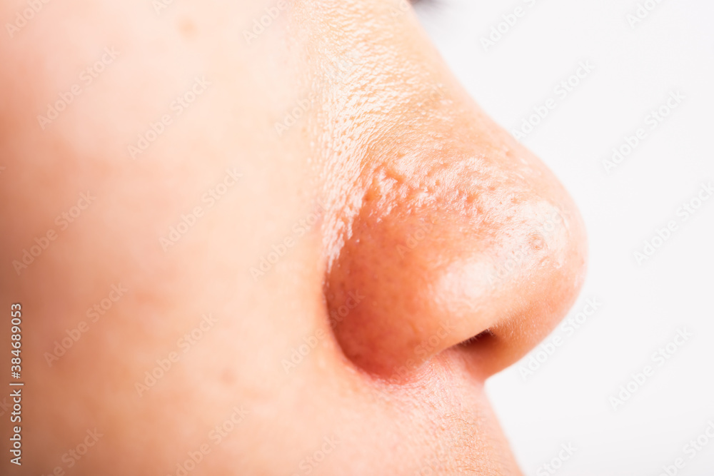 Fototapeta premium Closeup Asian young woman large pores have freckles cheek oily, acne pimple on nose, studio shot isolated on white background, Healthcare beauty skin face problem concept