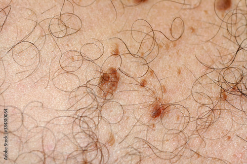 Brown spot on the skin. Pigmented spots and moles. Mole and skin hair.