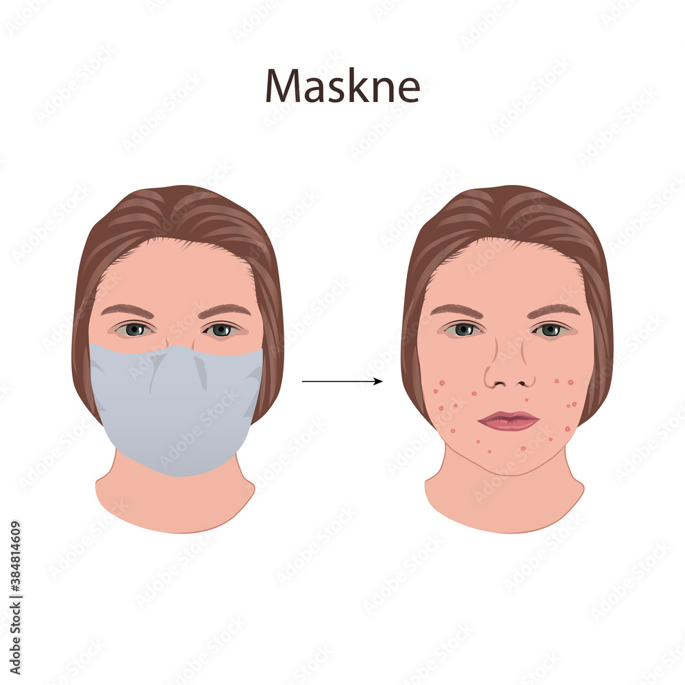 Obraz premium Maskne. Wearing mask problems. Young woman face with acne.