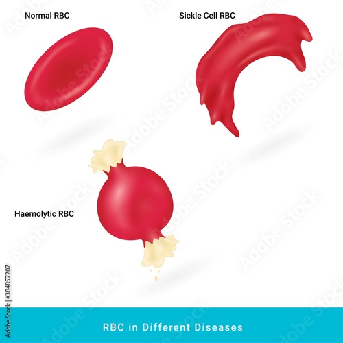 Red blood cells in Normal condition, hemolytic and sickle cell state. RBC abnormal shapes comparison. 
