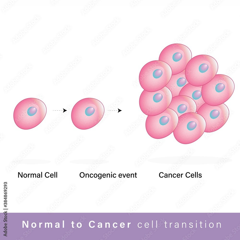 Cancer cell transition or tumor cell formation and development ...
