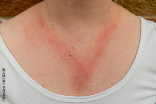 A white lady with allergic contact dermatitis red rash on chest and neck from reaction to nickel jewellery necklace