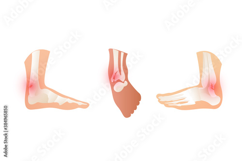 The ankle is broken, three sides, the joint is damaged. Disrupted leg bones on a white background. Pain and swelling with a fracture.